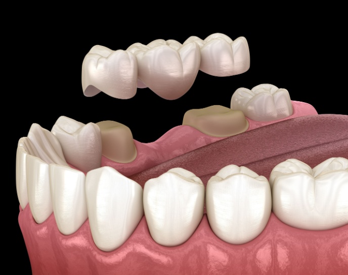 3D illustration of dental crowns and a dental bridge, showcasing cosmetic dentistry solutions for restoring smiles at Linrose Dental in Saratoga Springs.