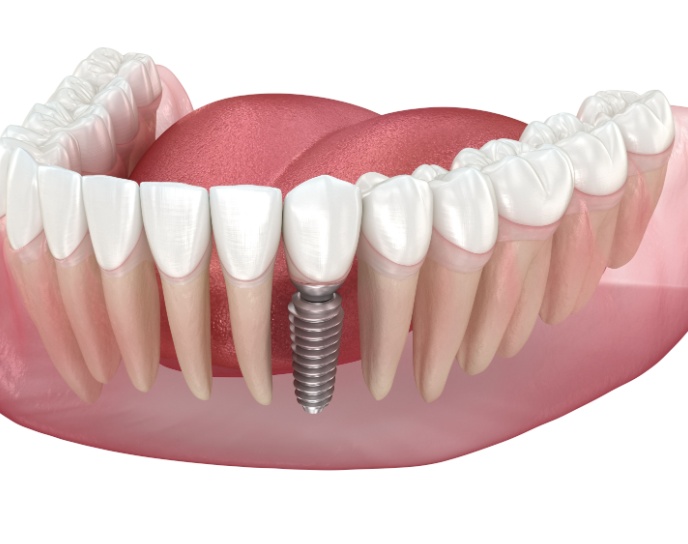 Dental implant model showcasing a titanium implant positioned in the jawbone, surrounded by natural-looking teeth, illustrating effective tooth replacement solutions offered at Linrose Dental in Saratoga Springs, UT.