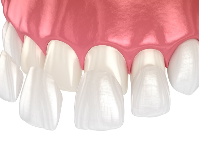 Detailed illustration of porcelain veneers applied to teeth, showcasing transformation for cosmetic dentistry at Linrose Dental in Saratoga Springs, UT.