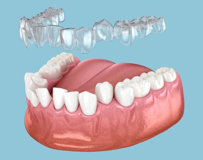 Invisalign clear aligners above a dental model showcasing teeth and gums, illustrating orthodontic treatment options at Linrose Dental in Saratoga Springs, UT.
