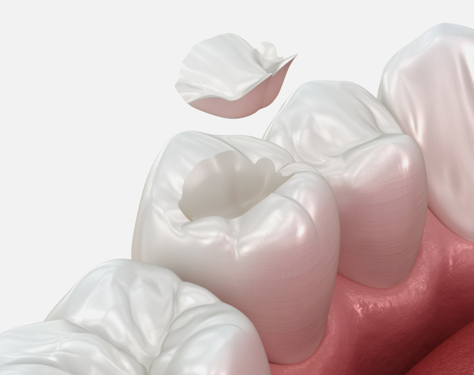 Dental filling placed in a decayed tooth, with a missing piece above, illustrating restorative dentistry techniques at Linrose Dental in Saratoga Springs, UT.