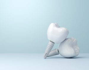 Dental implants featuring white tooth crowns and screws, symbolizing restorative dental solutions offered at Linrose Dental in Saratoga Springs, UT.