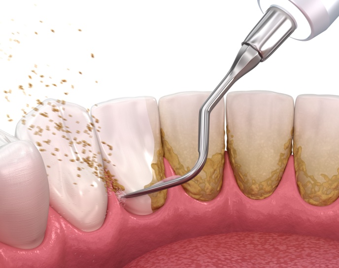 Dental hygienist performing deep cleaning on teeth to remove plaque and tartar buildup, highlighting periodontal treatment for gum disease management.