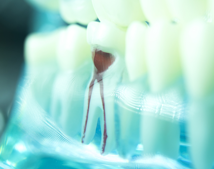 Model of a tooth highlighting the root canal anatomy, showcasing the interior chamber and pulp tissue, relevant to restorative dentistry and root canal procedures.
