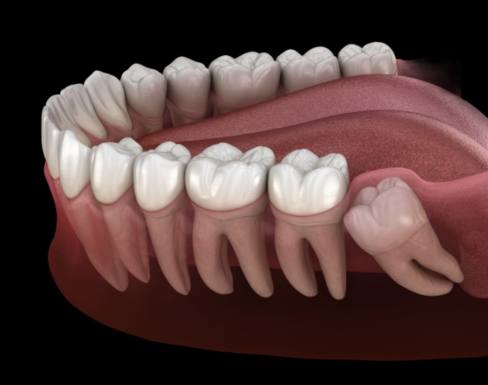 3D illustration of a human jaw showing impacted wisdom teeth, emphasizing dental health and extraction relevance.